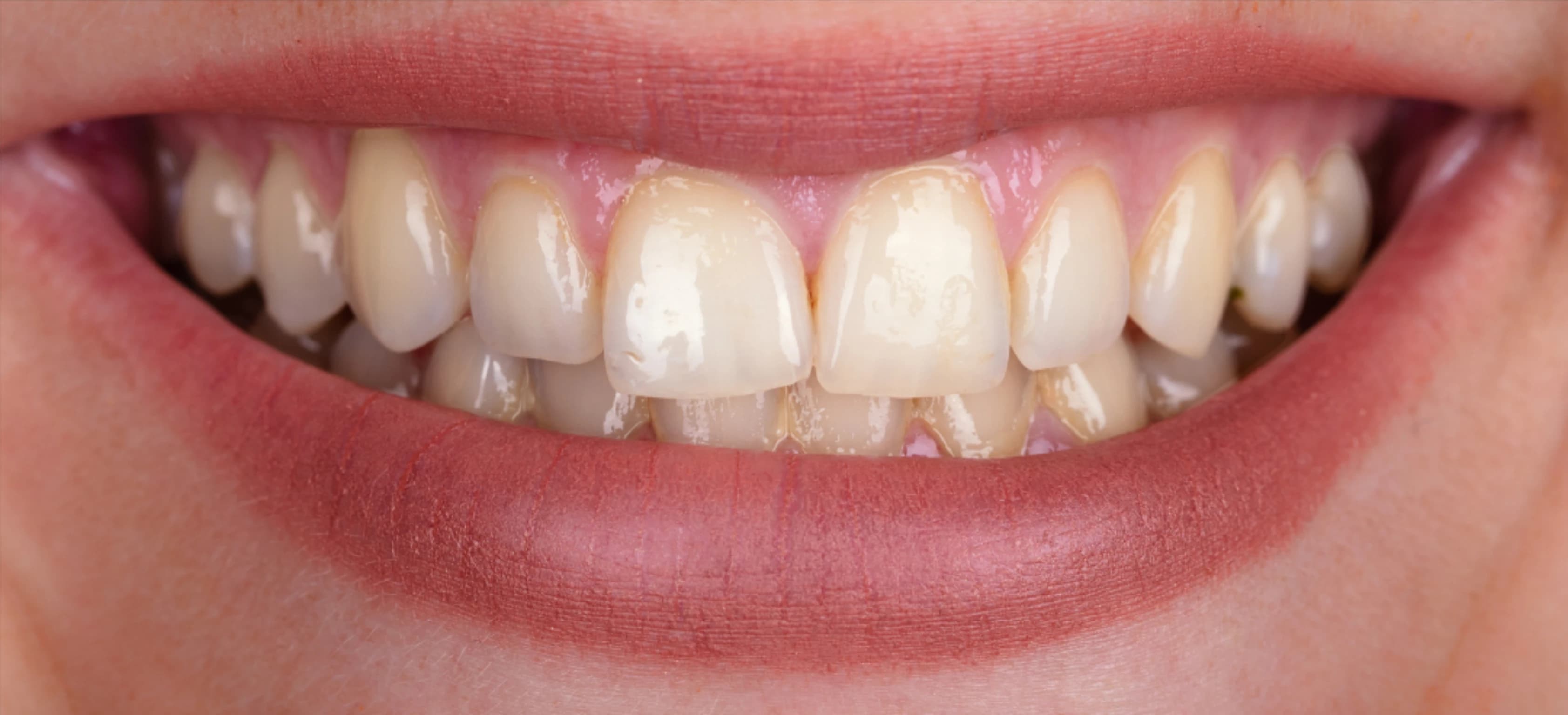 Resultado do clareamento dental - Antes