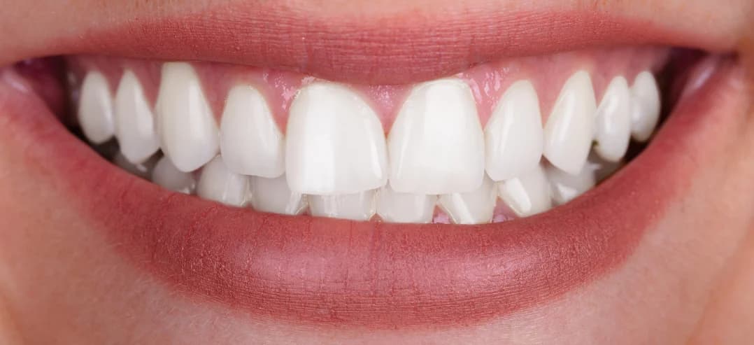 Resultado do clareamento dental - Depois